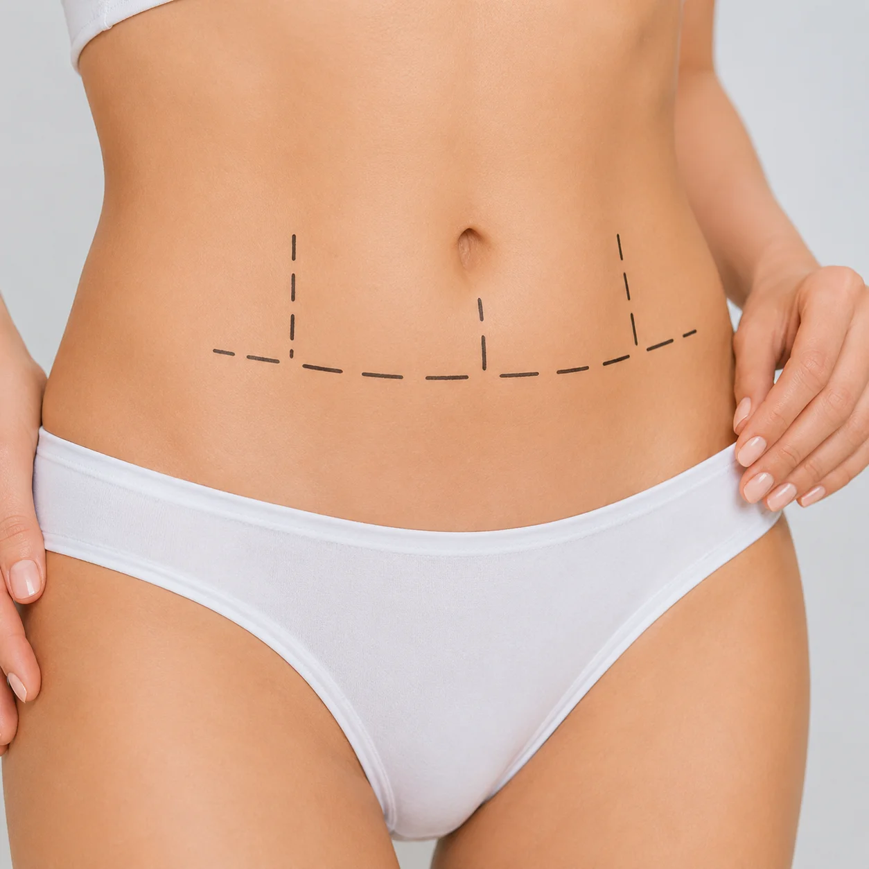Abdominoplastica